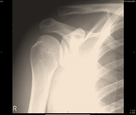 Xrays of severe shoulder separation