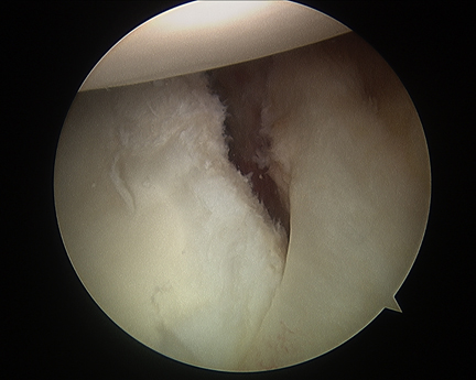 other anterior labral tears