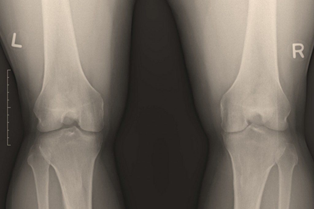 Knee OA after successful trial
