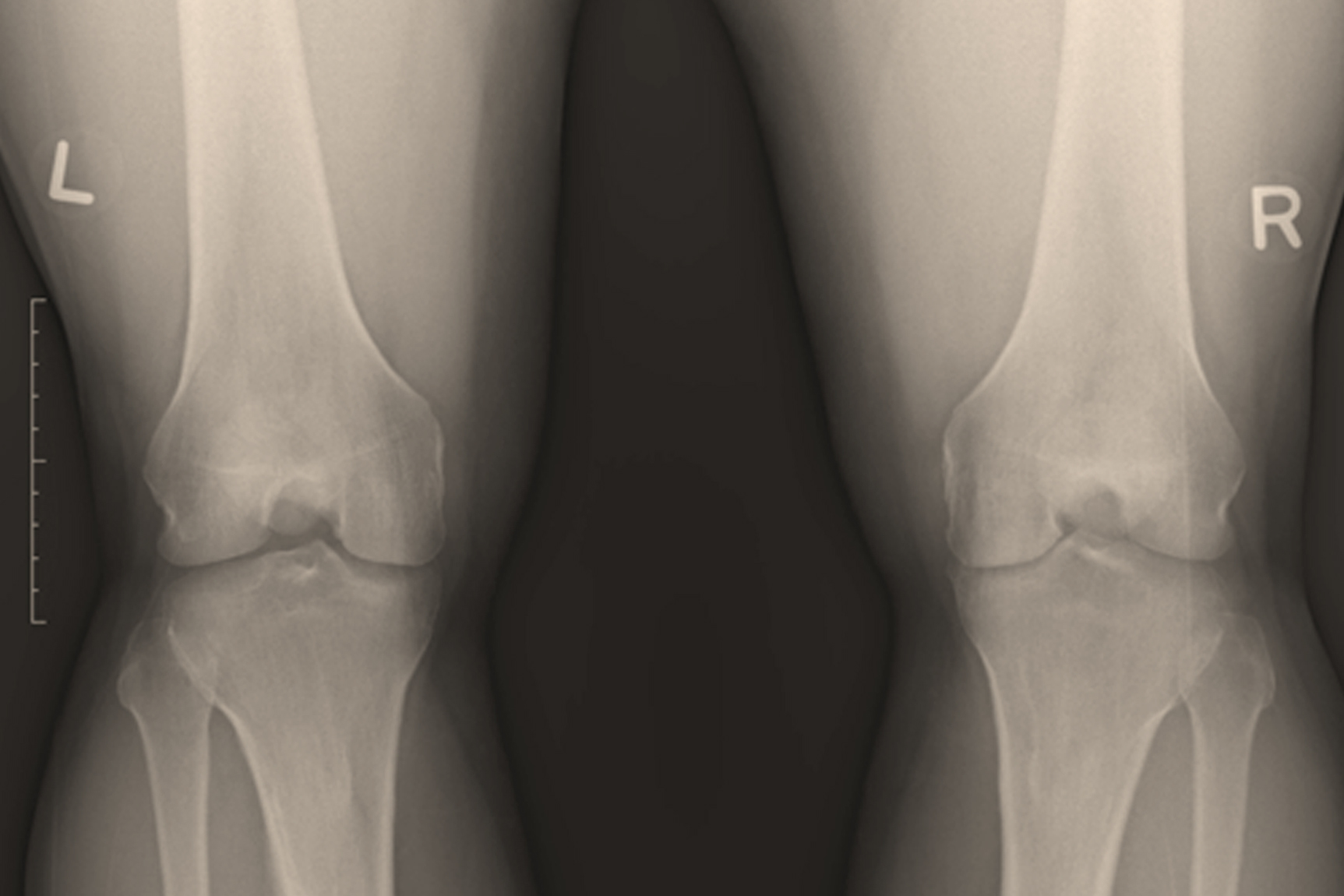 Knee Osteoarthritis Treatment Injections Fibroblast Human Growth Factor