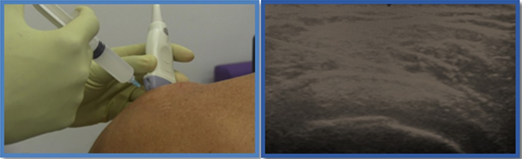 ultrasound guided shoulder injection